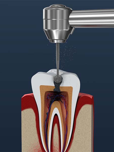 indirect-pulp-therapy-dental-care-oral-health