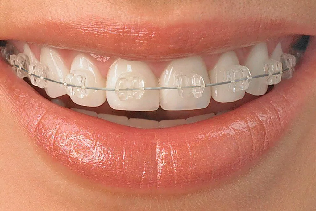 invisible ceramic braces example