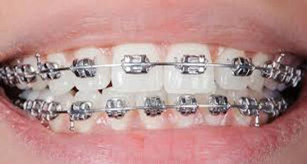 metal braces