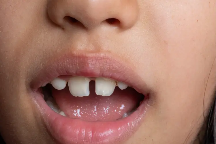 missing teeth causing teeth gaps