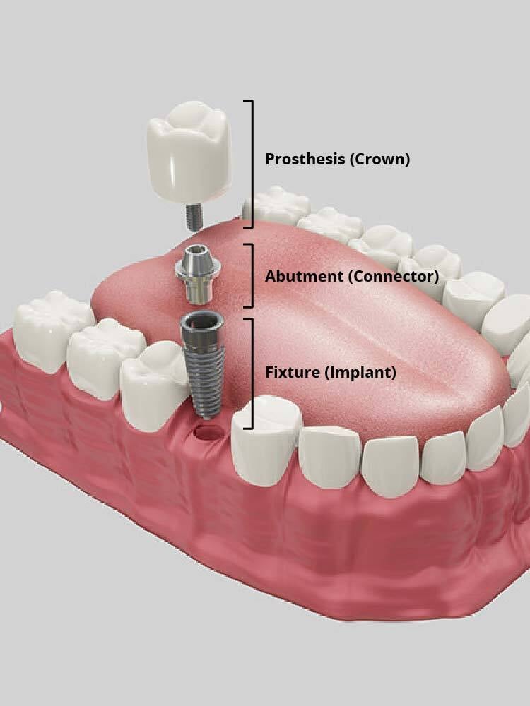 new-what-is-a-dental-Implant-01