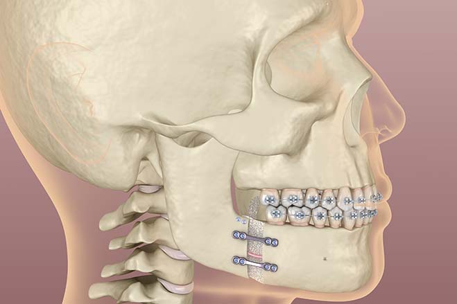 orthognathic-surgery-dental-care-oral-health