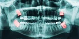 Panoramic dental X-ray (OPG) showing both upper and lower jaws