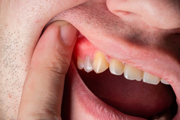 periodontal disease
