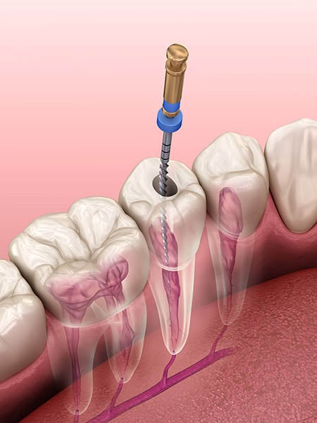 root-canal-treatment-1