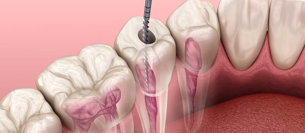 root canal image