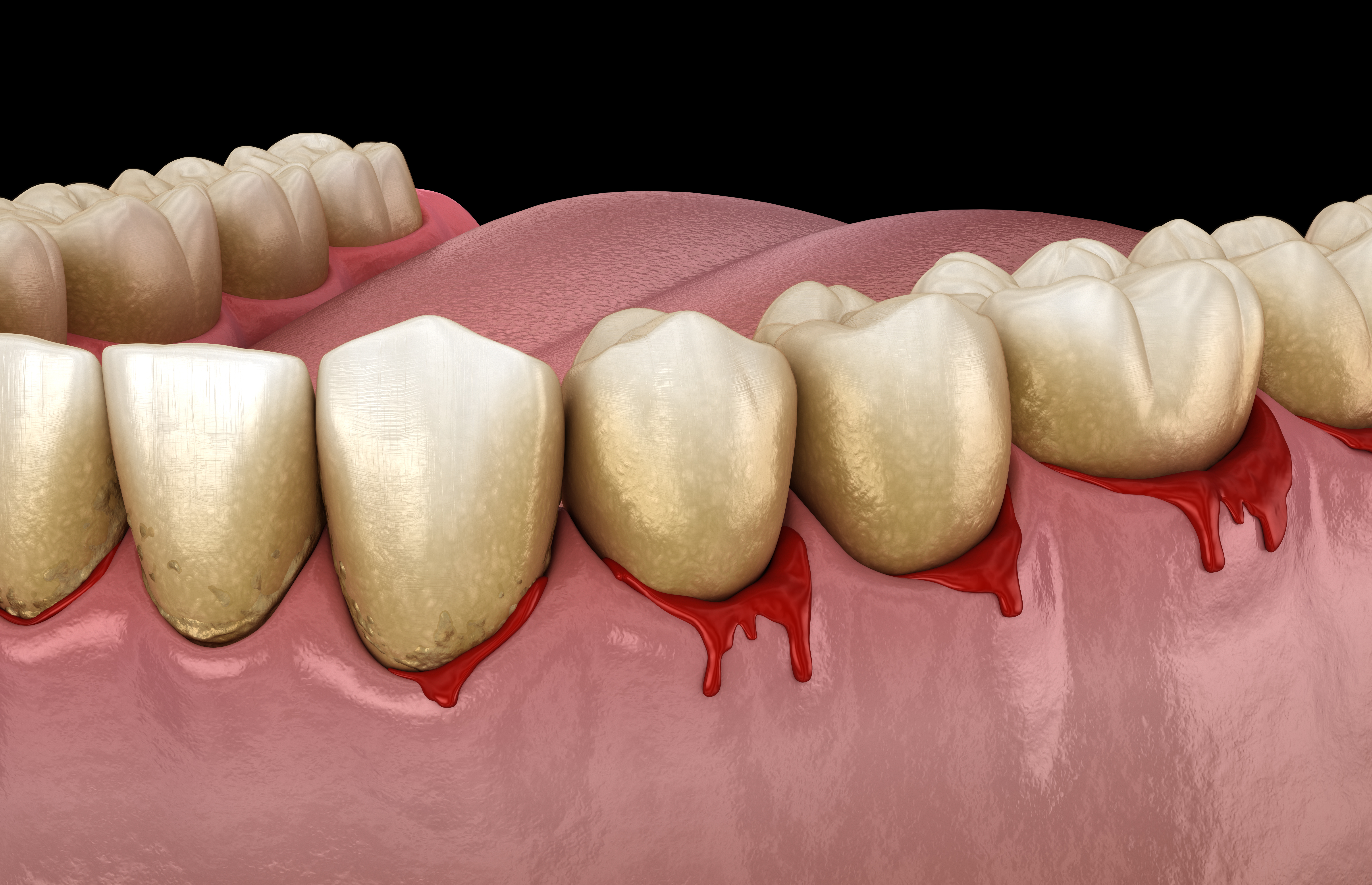 gum disease