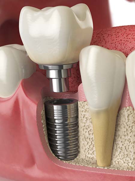 single-tooth-dental-implants-dental-care-oral-health-check-up