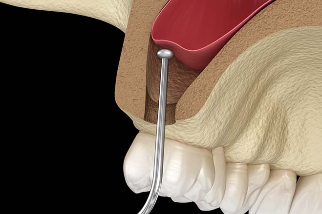 sinus-lift-dental-care-oral-health-check-up