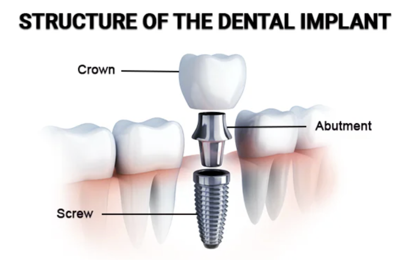 structure of the dental implant