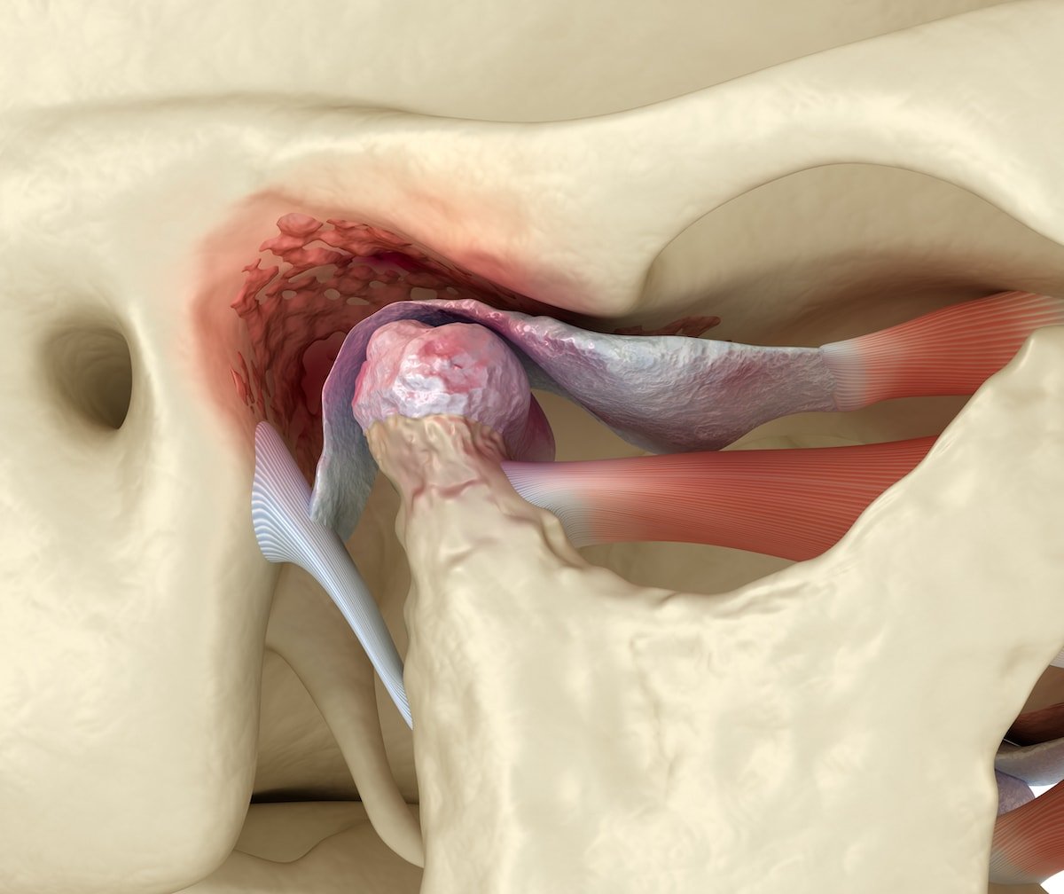 tmj pain illustration