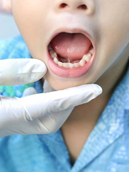 tongue-tie release-kid-dental-care-oral-health