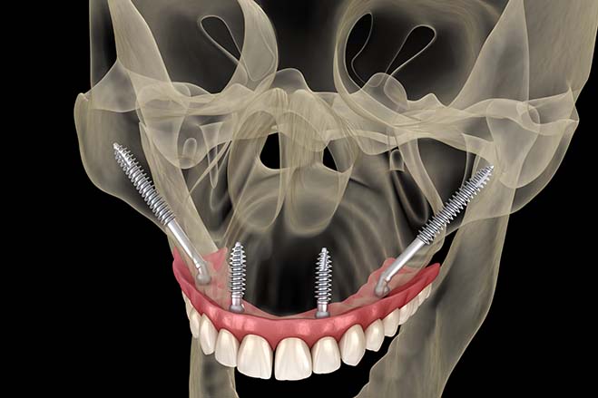 tubero-pterygoid-dental-implants-dental-care-check-up-oral-health