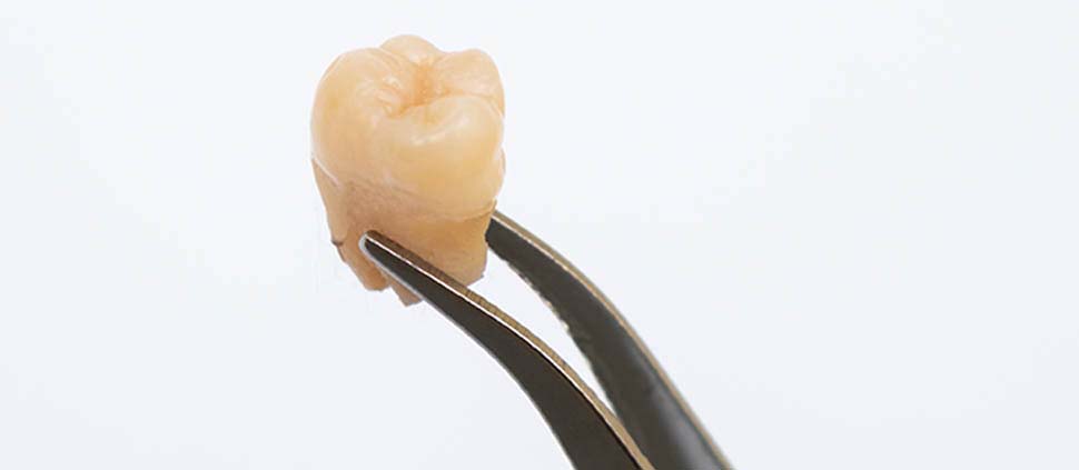 tweezer-holding-old-removed-crack-wisdom-tooth-mouth-isolated-dentist-found-unhealthy-damaged-cavities-teeth-cause-pain-toothache-dentistry-hospital-1