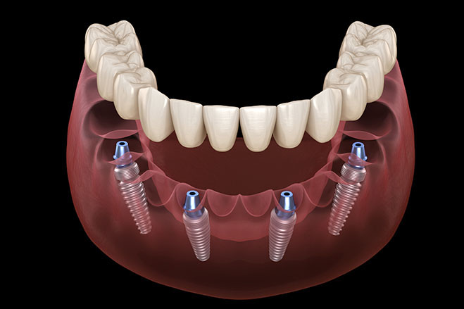 what-are-all-on-4-dental-implants