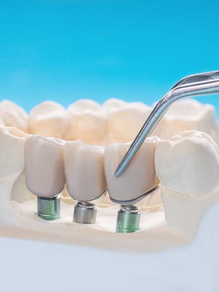 what-are-multi-teeth-dental-implants-oral-health-dental-care