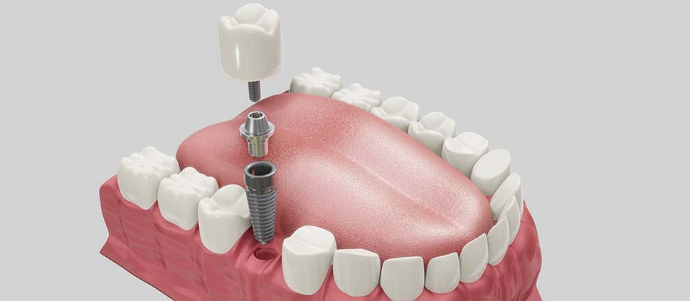 implant diagram