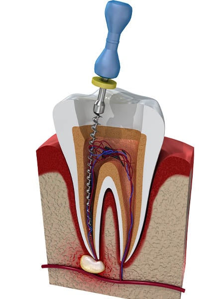 what-is-a-root-canal