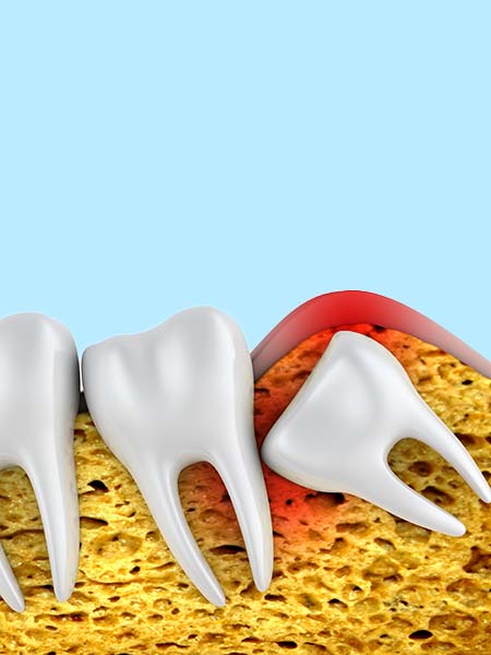 what-is-wisdom-tooth-surgery