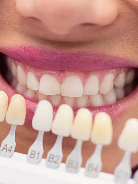 why-may-i-need-a-veneer-smile-dental-care-oral-health