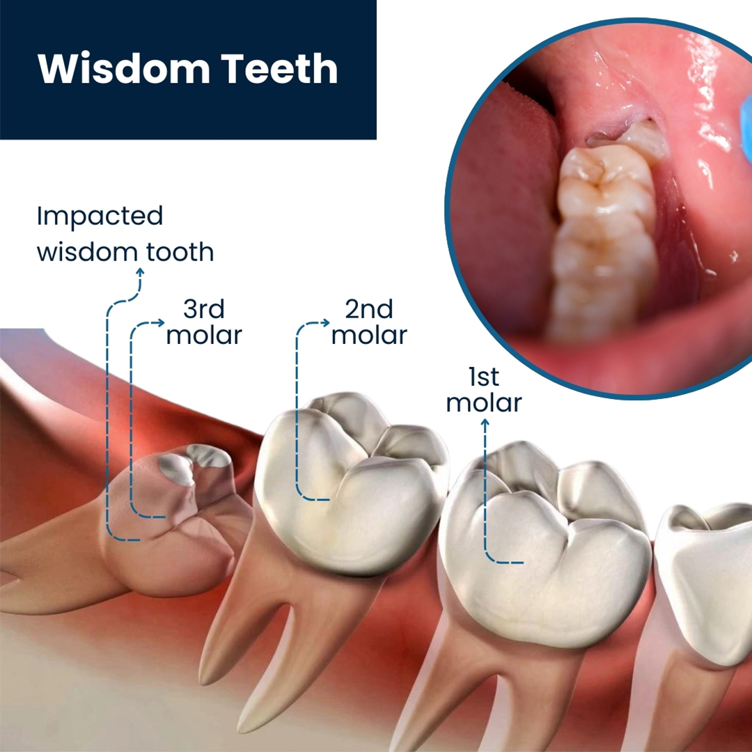 wisdom tooth pain
