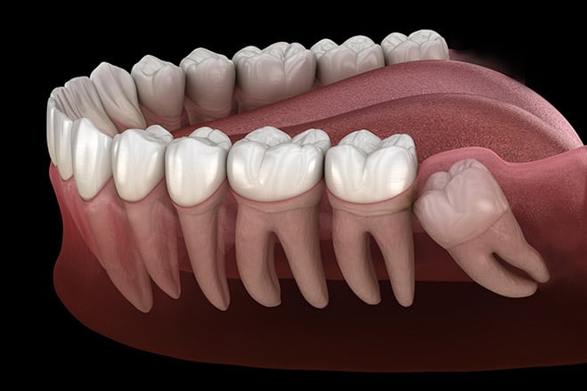 wisdom-tooth-surgery