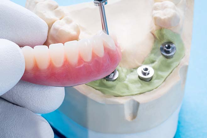 zirconia-crowns-dental-care-oral-health