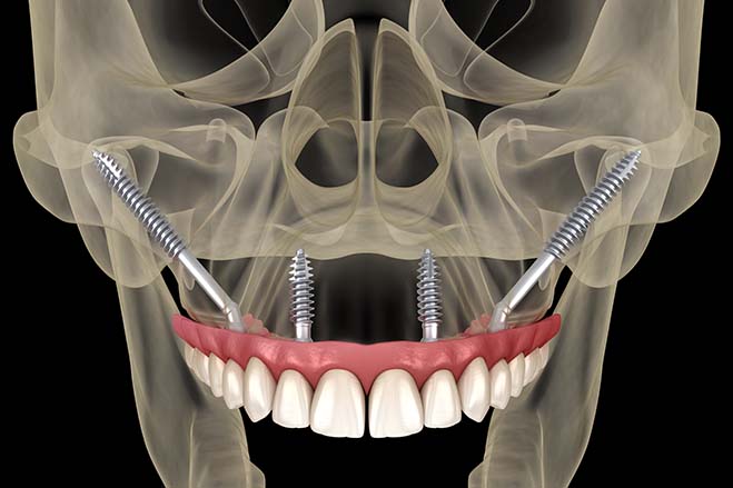 zygomatic-dental-implants-check-up-dental-care-oral-health